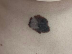 Melanoma malign